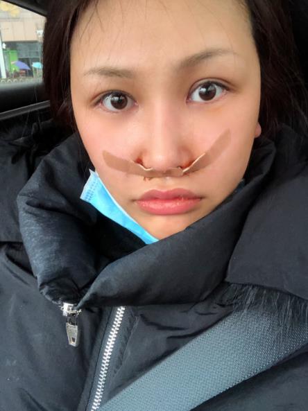 長(zhǎng)春中研整形黃帝云鼻頭縮小案例術(shù)后第二天