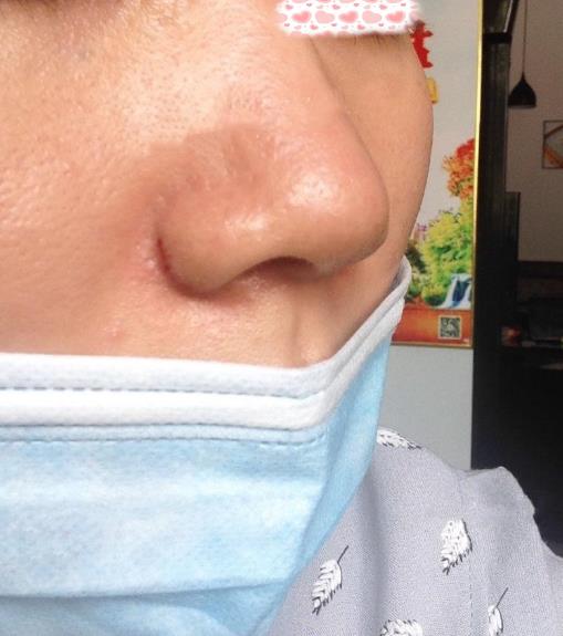 西安米蘭柏羽整形手術(shù)縮鼻翼案例分享術(shù)后一個月效果