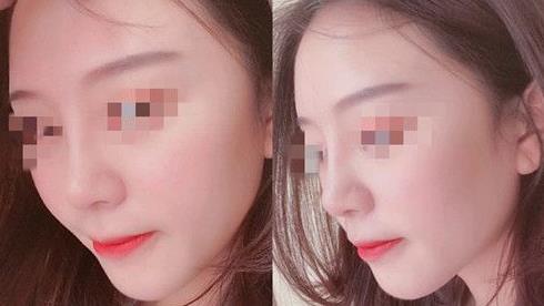 首都醫(yī)科大學(xué)附屬北京友誼醫(yī)院醫(yī)學(xué)美容中心耳軟骨隆鼻案例術(shù)后三個(gè)月效果