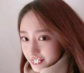 北京彤美耳軟骨隆鼻三個月效果分享，吐血推薦