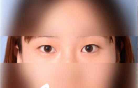 延吉金光善整形雙眼皮案例分享術(shù)前效果 延吉金光善整形雙眼皮案例分享術(shù)前效果