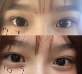 做雙眼皮案例，濟南坤如瑪麗崔金珍雙眼皮案例圖片