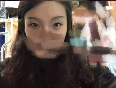 做雙眼皮案例，北京藝星張順慶雙眼皮案例圖片