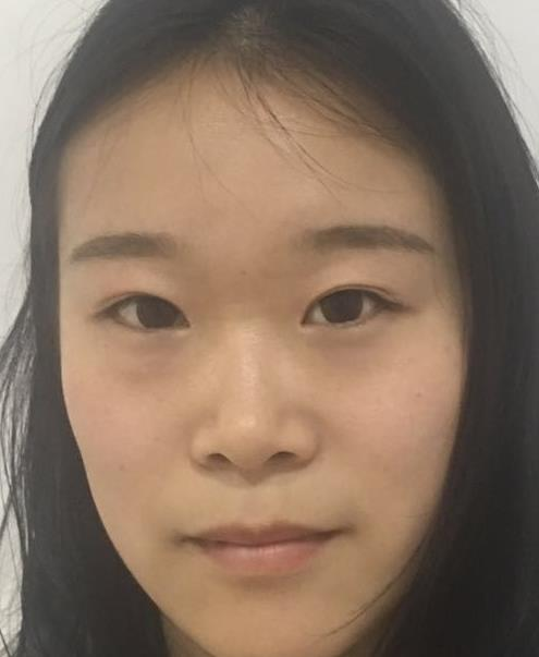 石家莊諾萬整形肋軟骨隆鼻案例分享，恢復(fù)過程圖