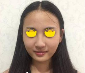 塌鼻子小妹在深圳鵬愛做隆鼻手術(shù)，三個月后竟然是這樣的