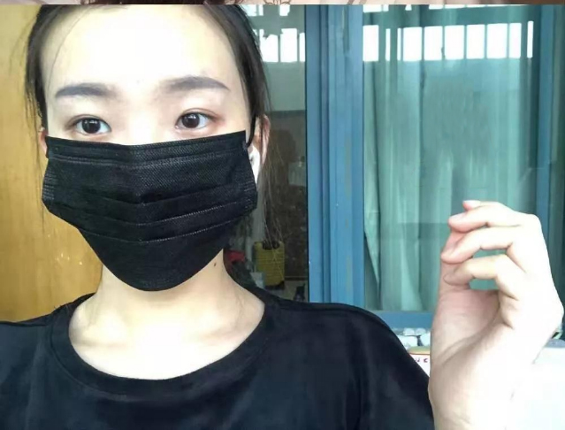 做雙眼皮案例，北京藝星張順慶雙眼皮案例圖片