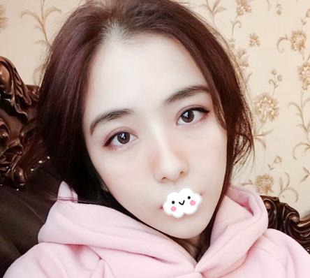 大連沙醫(yī)生整形付德林做的自體軟骨隆鼻術(shù)后兩個月效果