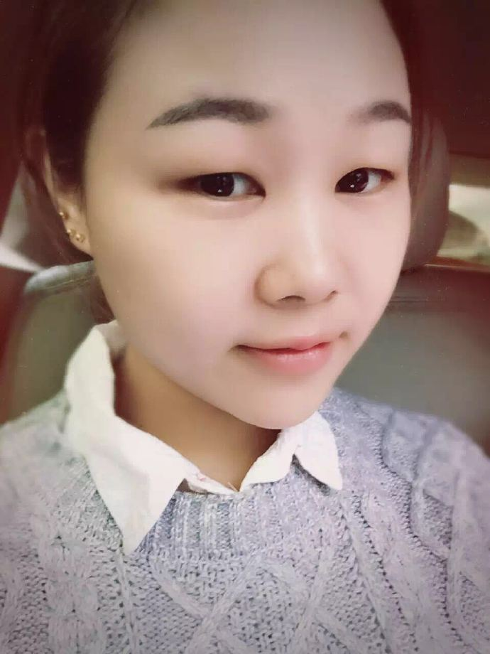 腫眼泡應(yīng)該做哪種雙眼皮？汕頭曙光雙眼皮三個月效果分享