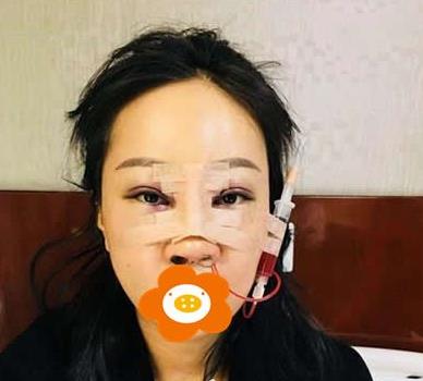鄭州禾麗做肋軟骨隆鼻術(shù)后兩天效果