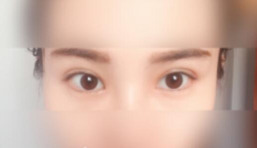 延吉金光善整形雙眼皮一個(gè)月效果 延吉金光善整形雙眼皮一個(gè)月效果