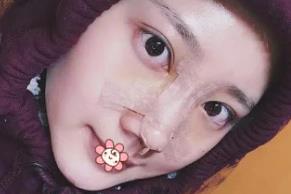 北京彤美耳軟骨隆鼻案例分享術(shù)后兩天效果 北京彤美耳軟骨隆鼻案例分享術(shù)后兩天效果
