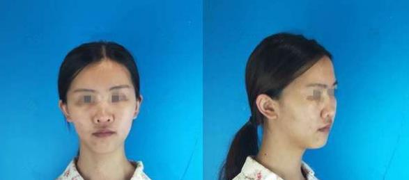濱州醫(yī)學(xué)院附屬醫(yī)院做隆鼻術(shù)前效果