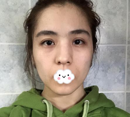 大連沙醫(yī)生整形付德林做的自體軟骨隆鼻術(shù)前效果