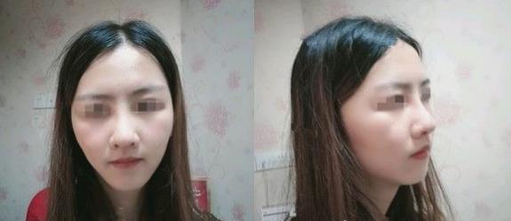 濱州醫(yī)學(xué)院附屬醫(yī)院做隆鼻一個(gè)月效果