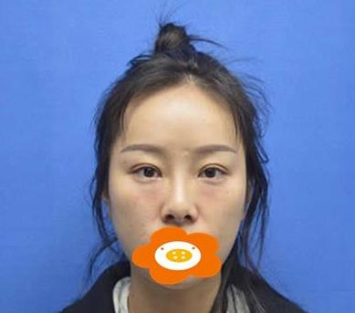 萬(wàn)萬(wàn)沒想到在鄭州禾麗做的肋軟骨隆鼻效果居然是這樣的