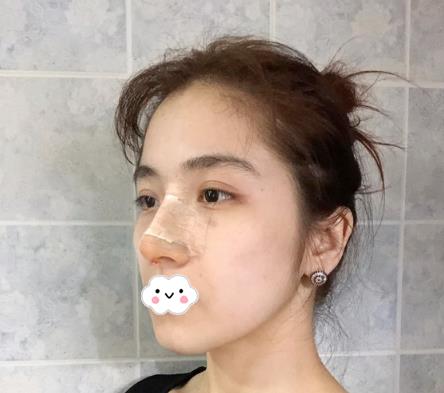 大連沙醫(yī)生整形付德林做的自體軟骨隆鼻術(shù)后第二天效果