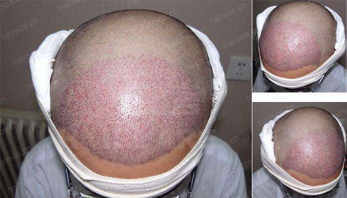 南京美貝爾發(fā)際線種植案例術(shù)后一個(gè)月