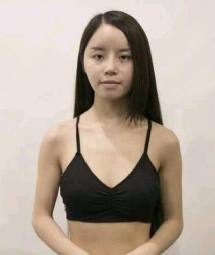 福州海峽假體隆胸案例分享，這個胸就很上頭
