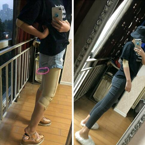 成都趙博士整形大腿吸脂案例一個(gè)月效果