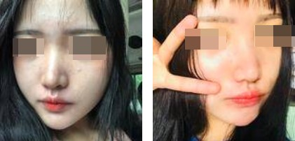 一個(gè)鼻子讓一張臉迅速高級(jí)，還不考慮做個(gè)鼻綜合嗎