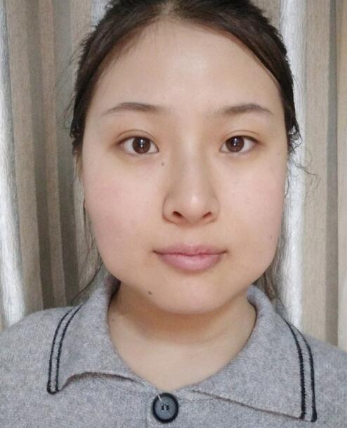 杭州時(shí)光磨骨案例術(shù)前效果