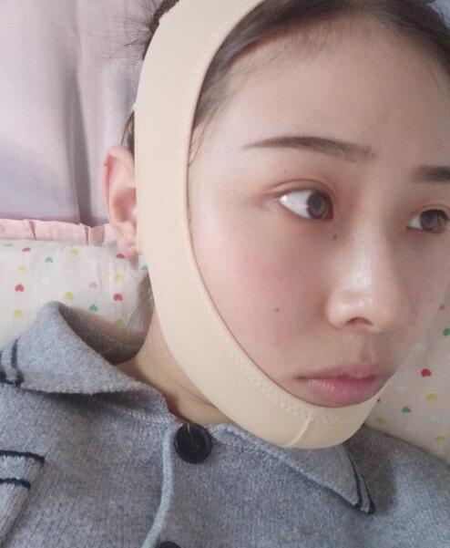 杭州時(shí)光磨骨案例術(shù)后一個(gè)月效果