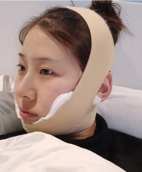 杭州時(shí)光磨骨案例術(shù)后一周效果