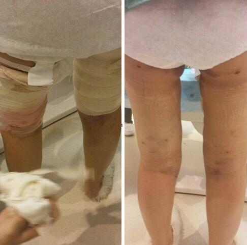 4800做的大腿吸脂，效果竟然還不錯