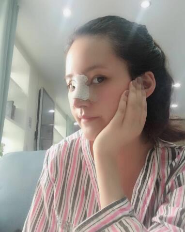 北京葉子整形肋軟骨隆鼻案例手術(shù)當(dāng)天側(cè)面