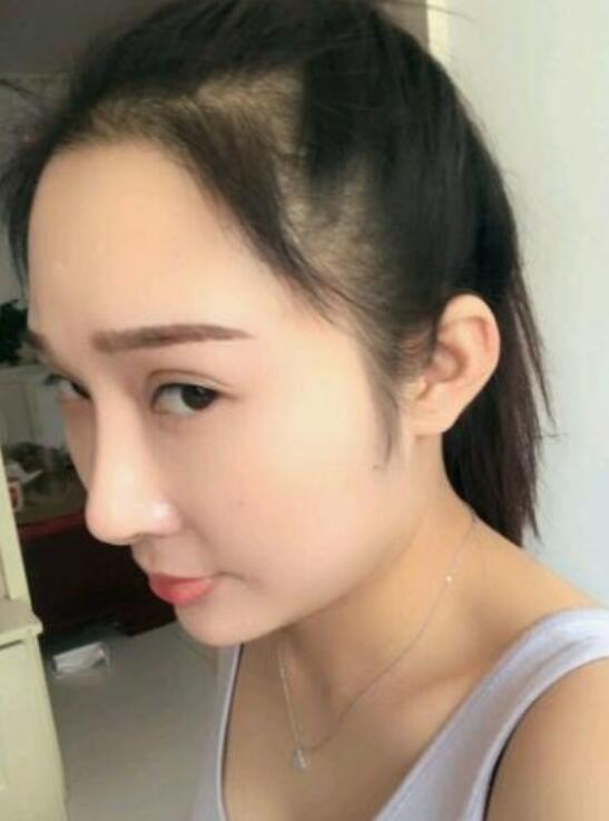 溫州新生植發(fā)種植發(fā)際線案例反饋，與大腦門說拜拜