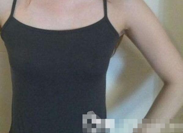 吉安第二醫(yī)院妙桃假體隆胸案例術(shù)前效果