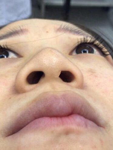 深圳福華整形陳貞宜超體隆鼻術后一個月效果反饋，有圖