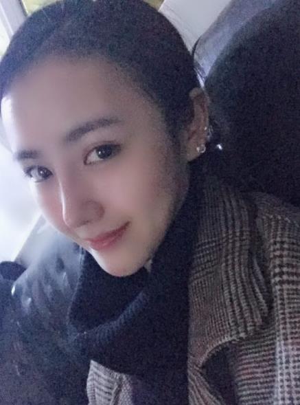 北京藝美整形鼻綜合案例術(shù)后兩個月 北京藝美整形鼻綜合案例術(shù)后兩個月