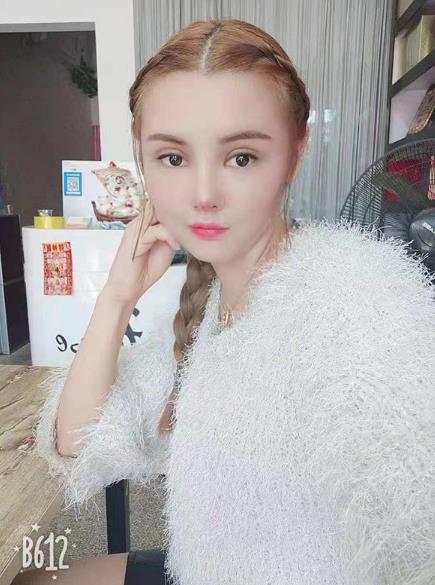 長沙雅美眼鼻整形案例術(shù)后一個(gè)月效果