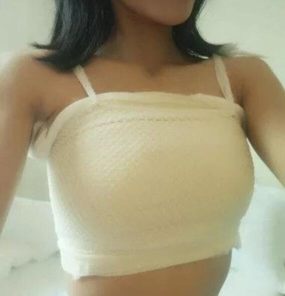 吉安第二醫(yī)院妙桃假體隆胸案例術(shù)后第三天效果