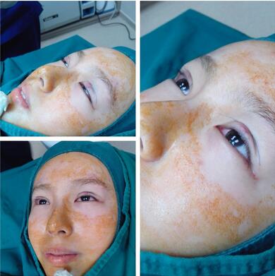 萍鄉(xiāng)麗芙整形埋線雙眼皮術(shù)后即刻 萍鄉(xiāng)麗芙整形埋線雙眼皮術(shù)后即刻