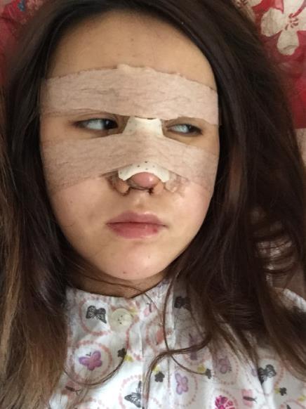 北京藝美整形鼻綜合案例術(shù)后第二天 北京藝美整形鼻綜合案例術(shù)后第二天