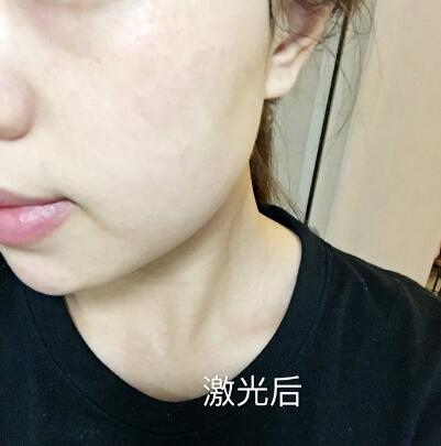 紹興維美整形激光祛斑兩個療程，皮膚像剝了殼的雞蛋