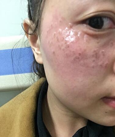 紹興維美整形激光祛斑當(dāng)天