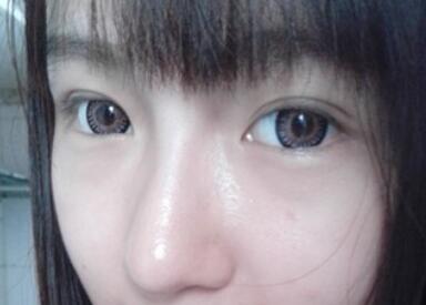 萍鄉(xiāng)麗芙整形埋線雙眼皮一個月 萍鄉(xiāng)麗芙整形埋線雙眼皮一個月