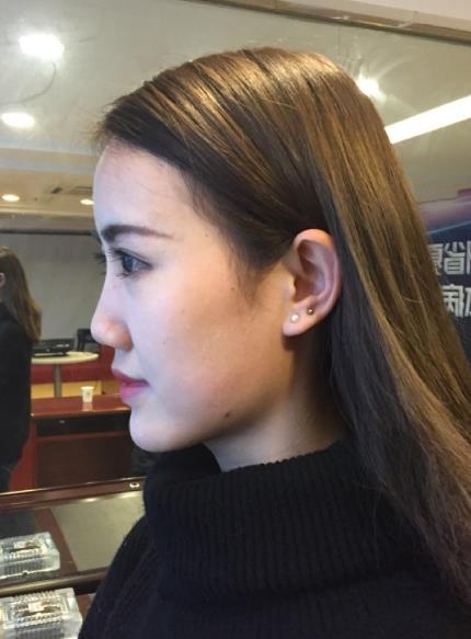 北京藝美整形鼻綜合案例術(shù)前 北京藝美整形鼻綜合案例術(shù)前