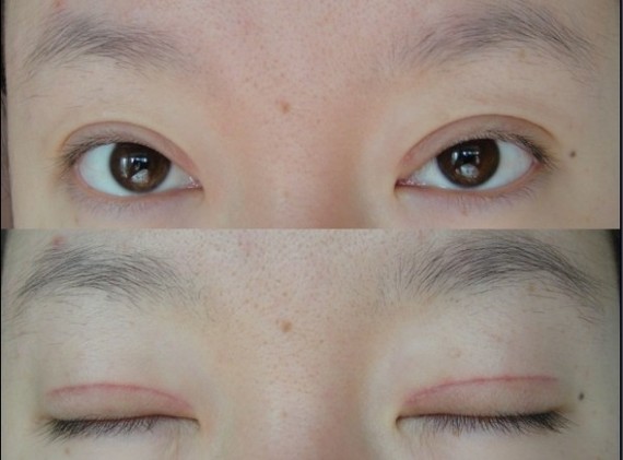 鄭州望京做全切雙眼皮+開(kāi)外眼角半個(gè)月