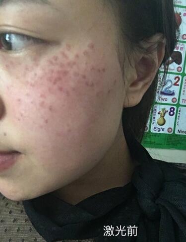 紹興維美整形激光祛斑當(dāng)天