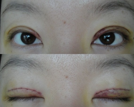 鄭州望京做全切雙眼皮+開(kāi)外眼角術(shù)后一周