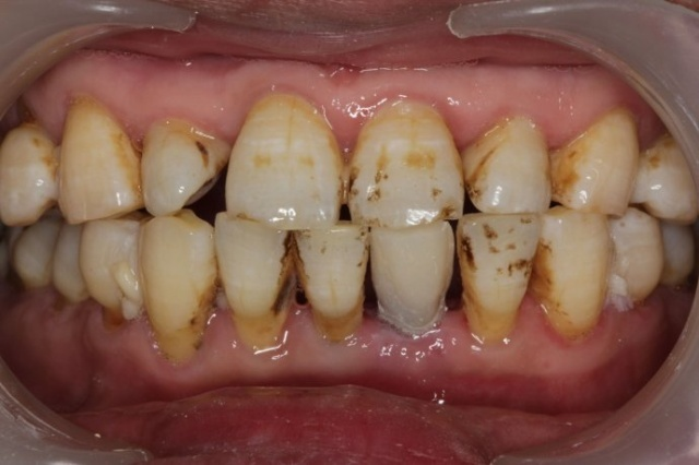 深圳正夫口腔種植牙案例分享，這下可以好好吃飯了