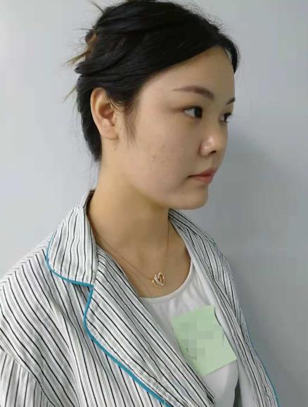 長沙雅美眼鼻整形案例術(shù)前效果