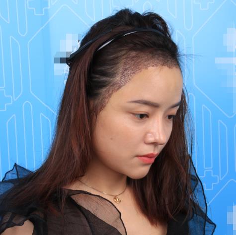 廈門新生植發(fā)種植發(fā)際線半個月 廈門新生植發(fā)種植發(fā)際線半個月