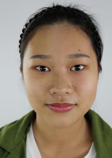 肇慶華美整形切開雙眼皮術前