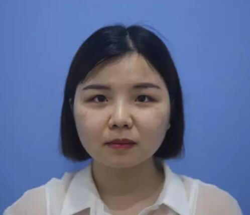 長沙星雅整形激光祛斑三個(gè)月效果分享，白白凈凈誰看了不愛