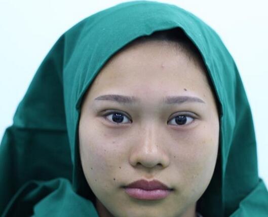 肇慶華美整形切開雙眼皮術后當天